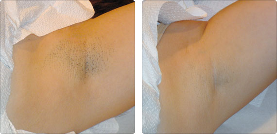 Элос эпиляция в Днепропетровске