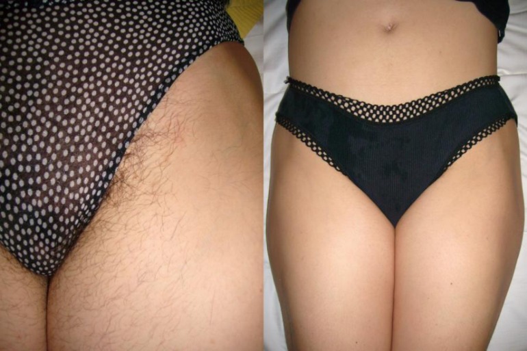 Элос эпиляция в Днепропетровске