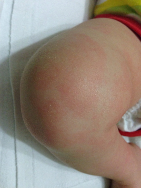 Что за пятна?(( Аллергия ли?