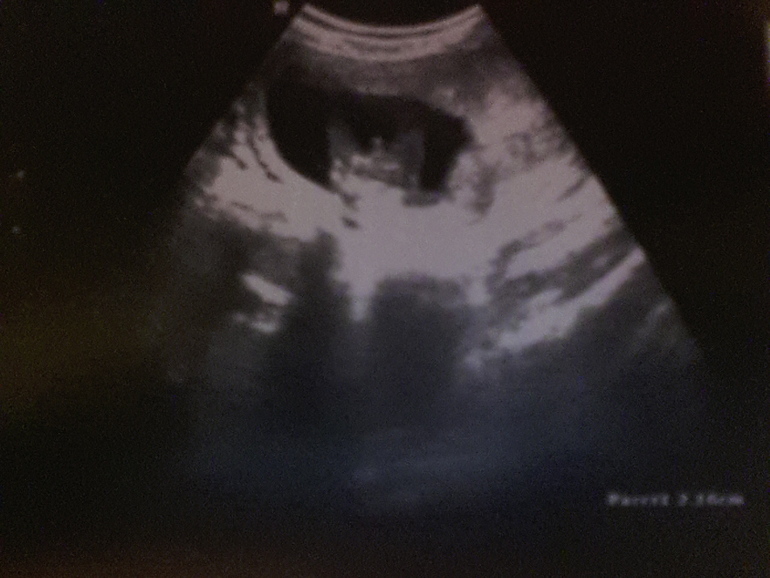 всем привет, а у нас будет мальчик, нам 17 неделик)))