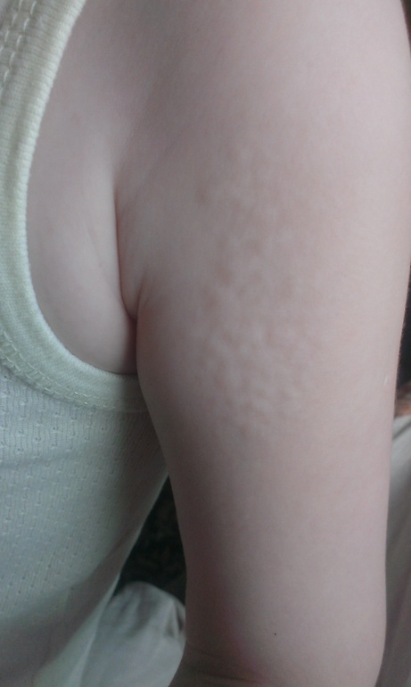 Вафельная кожа. Что это может быть?