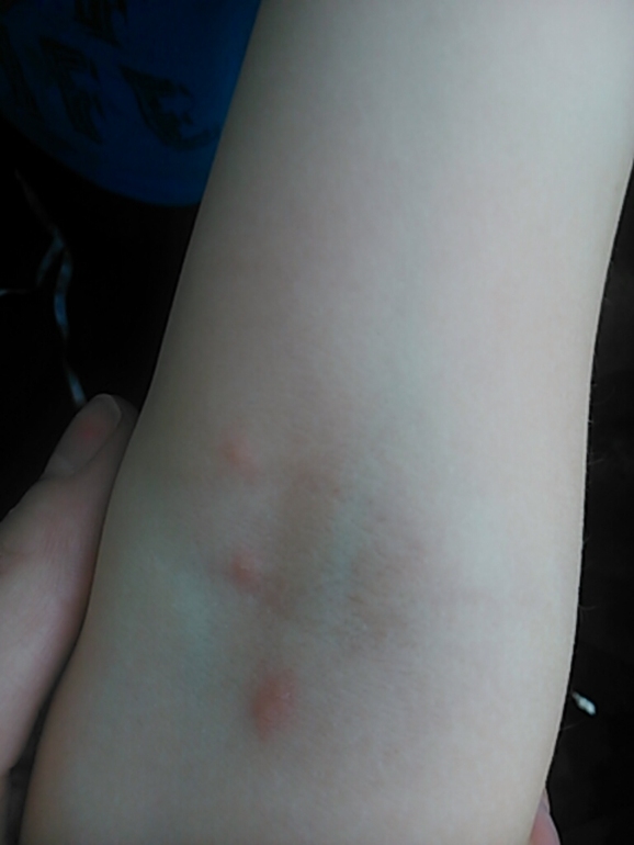 Ветрянка. Да или нет? А завтра летим отпуск....