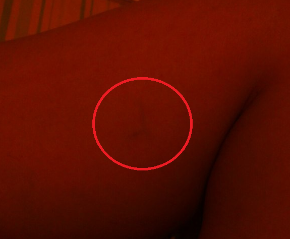 На ноге проступила венка - что это?