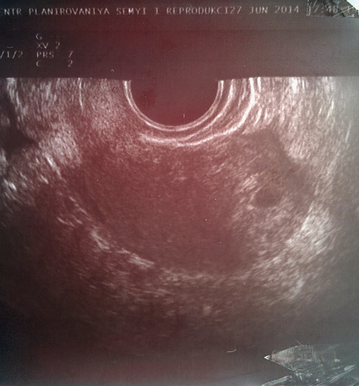 Первое УЗИ и мои новости