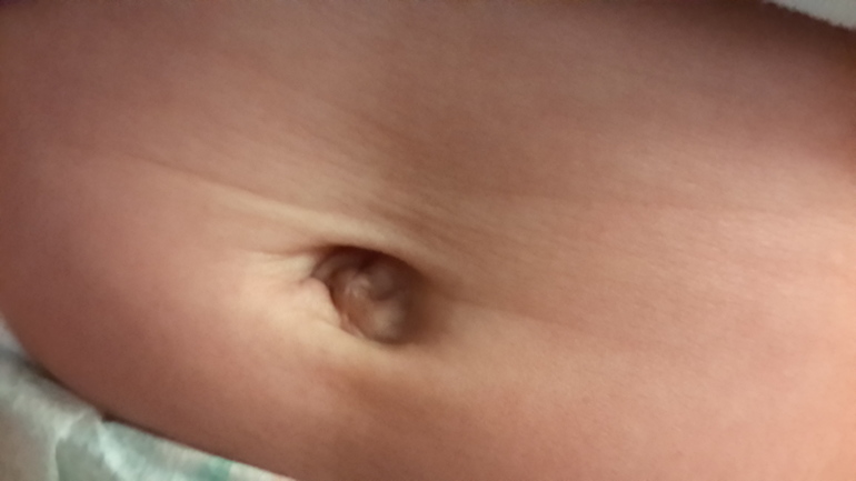 Что это на пупке?Девочки,кто с таким сталкивался?