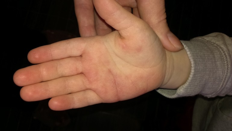 Сыпь на ладошке