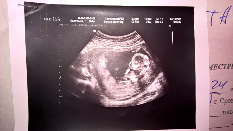 Узи 6 месяцев. Снимок УЗИ беременности 4 месяца. Беременность на УЗИ 3 месяца беременности. УЗИ 3 месяца беременности мальчик. Снимок УЗИ беременности 6 месяцев.
