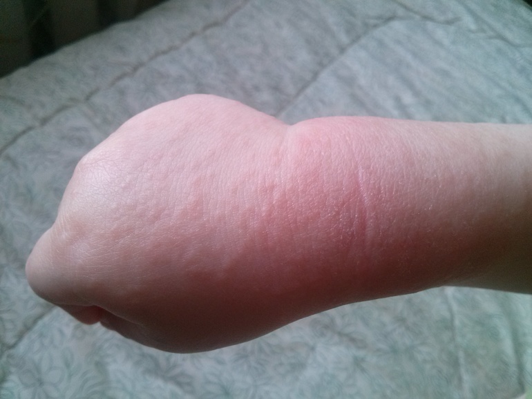 Аллергический дерматит