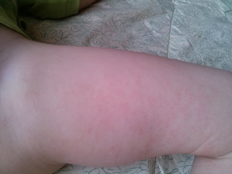 Аллергический дерматит