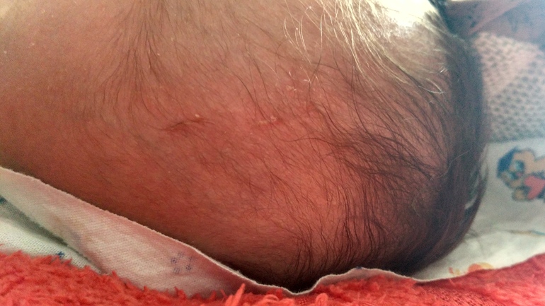 грудничок 12 дней- поцарапал лицо- чем обработать