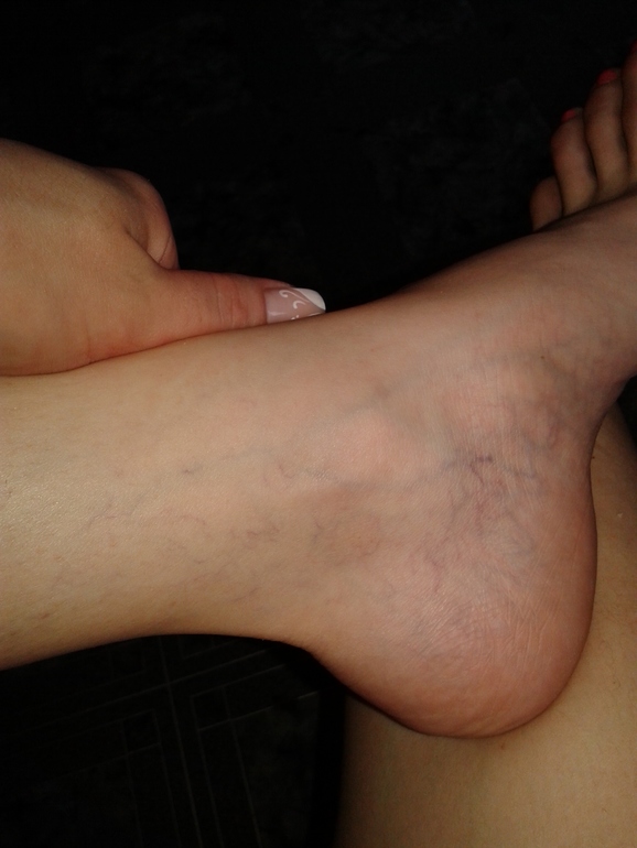 чем лечить звездочки на ногах