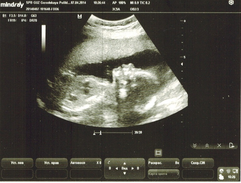 Узи показало - Девочку!