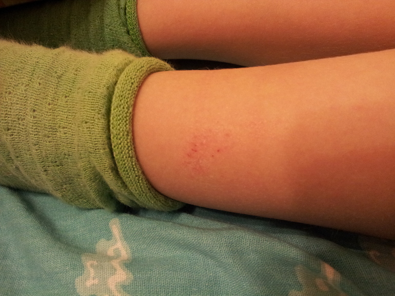 Не проходящая аллергия или это что-то еще после переезда