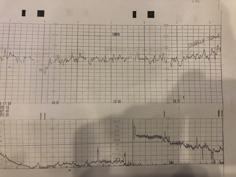 Ктг при схватках фото показатели
