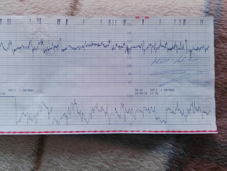 Ктг при схватках фото показатели