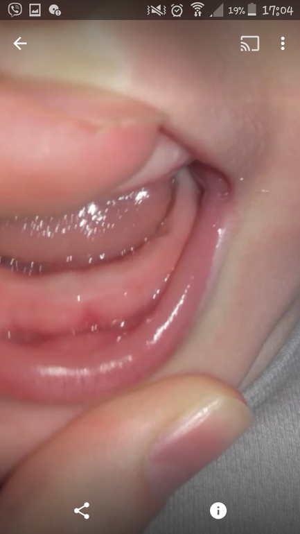 Прорезывание молочных зубов у детей
