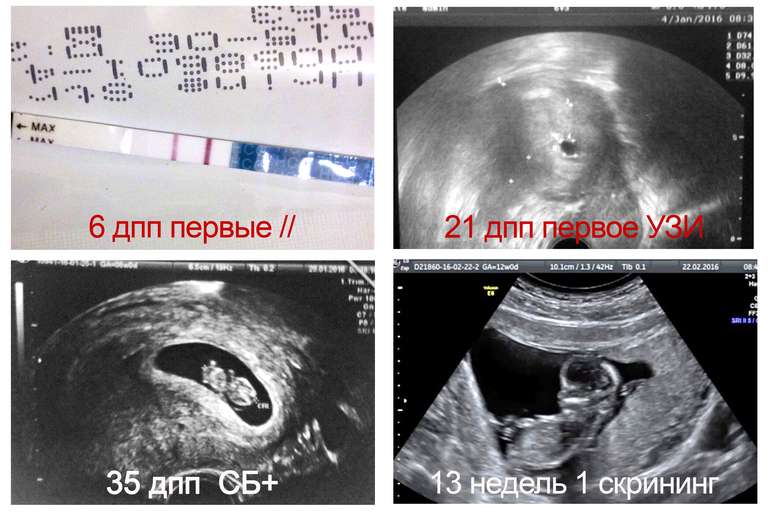 Узи первый. Снимок УЗИ беременность 1 триместр. УЗИ 1 триместр беременности фото. УЗИ 1 триместр беременности gid. Воспаление дёсен при беременности 1 триместр.