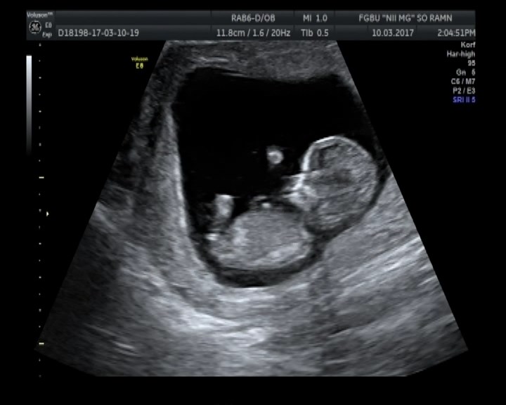 Узи 29 недель беременности мальчик фото