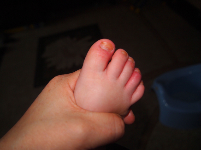 Похоже грибок