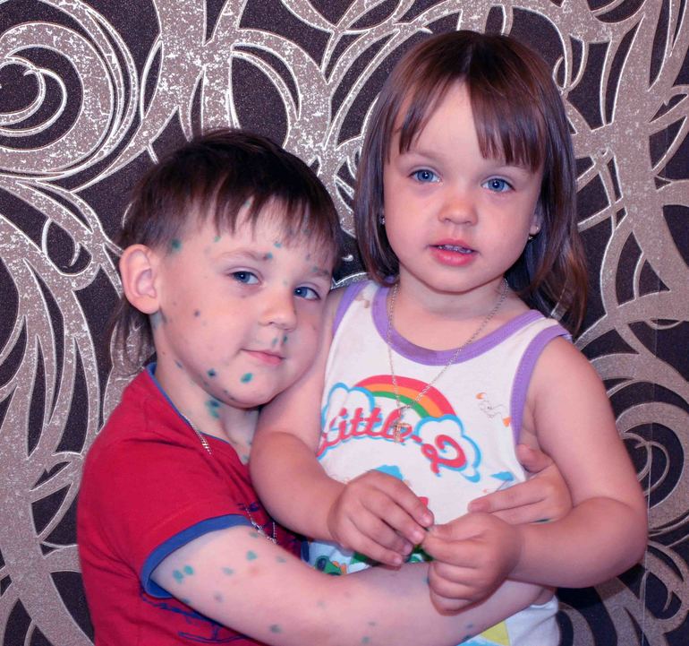 История ветрянки. Гордей.