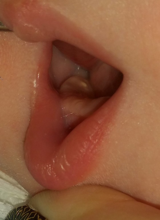 Лечение белого налета на языке у ребенка: всегда ли это молочница