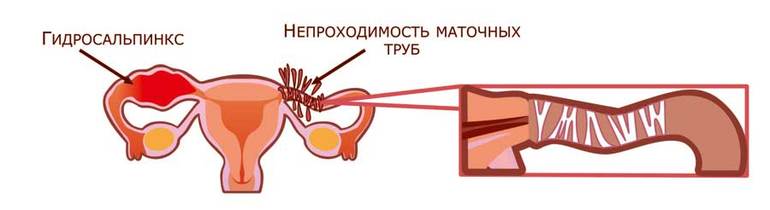 Перевязаны трубы задержка месячных причины кроме беременности