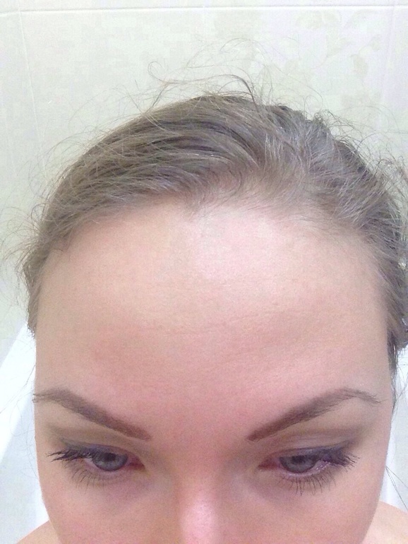 Пора на ботекс?