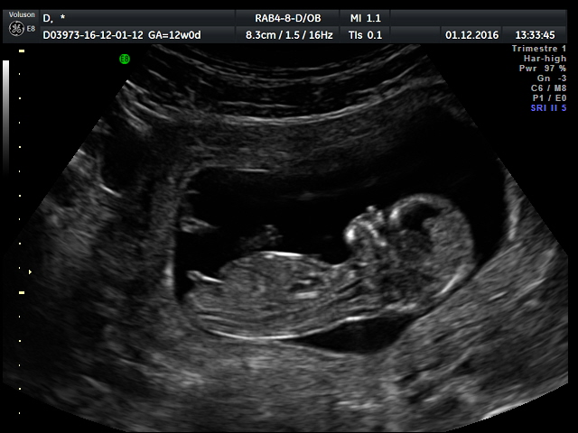 Мальчик на узи 12 недель. Мальчик и девочка на УЗИ В 12 недель беременности. УЗИ 12 недель беременности мальчик. Снимок УЗИ беременности 12 недель девочка. УЗИ мальчик 12-13 недель беременности.