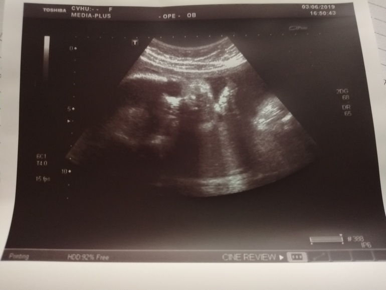 3 скрининг ростов