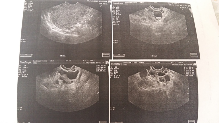 Эндометрий норма для зачатия. Эндометрий 8.9 мм фолликул 14 мм. Нормальная толщина эндометрия после овуляции. Эндометрий 13 мм после овуляции.