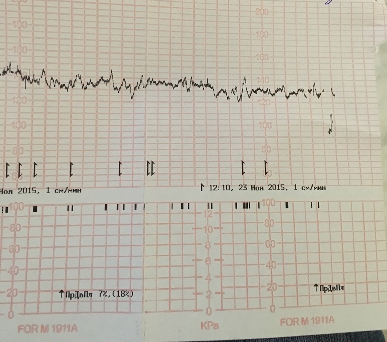 Ктг при схватках фото показатели