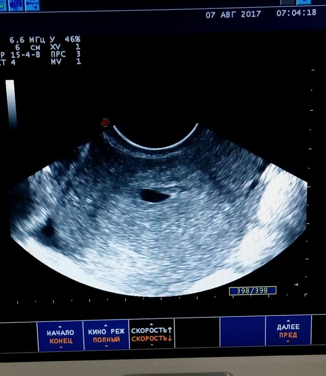 Узи видное отзывы. Желточный мешок и эмбрион на УЗИ. УЗИ на 19 ДПО.