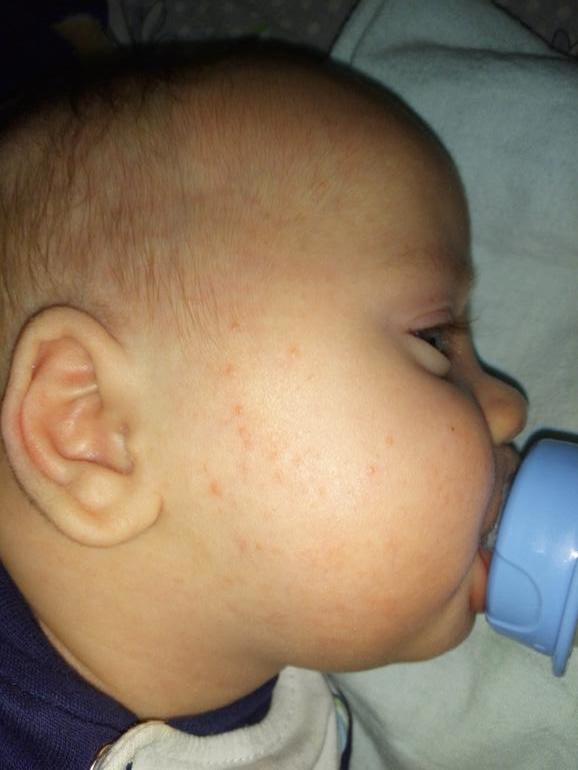 Реакция ребенка на другого ребенка. Аллергическая реакция на смесь Нутрилон 2. Аллергия на смесь Нутрилон премиум 1. Аллергия на смесь Нестожен 2. Аллергия на смесь Нутрилон премиум 1 у новорожденных.