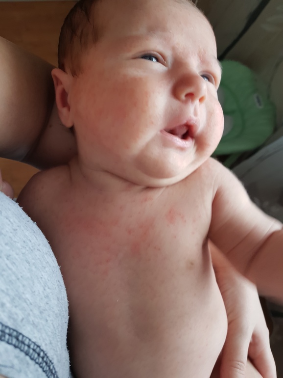 Аллергическая сыпь — 10 ответов | форум Babyblog