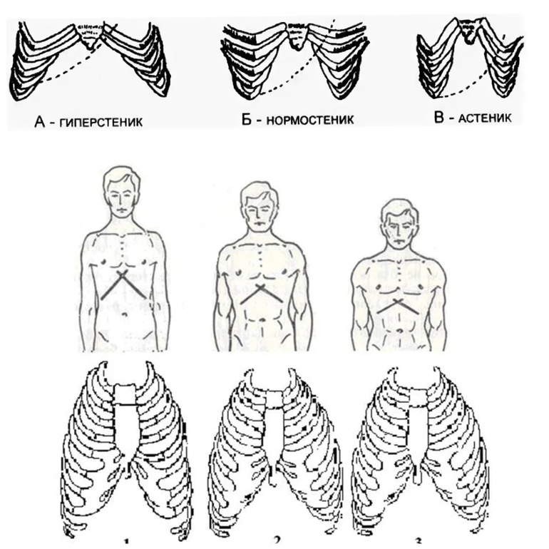 Ладьевидная грудная клетка рисунок