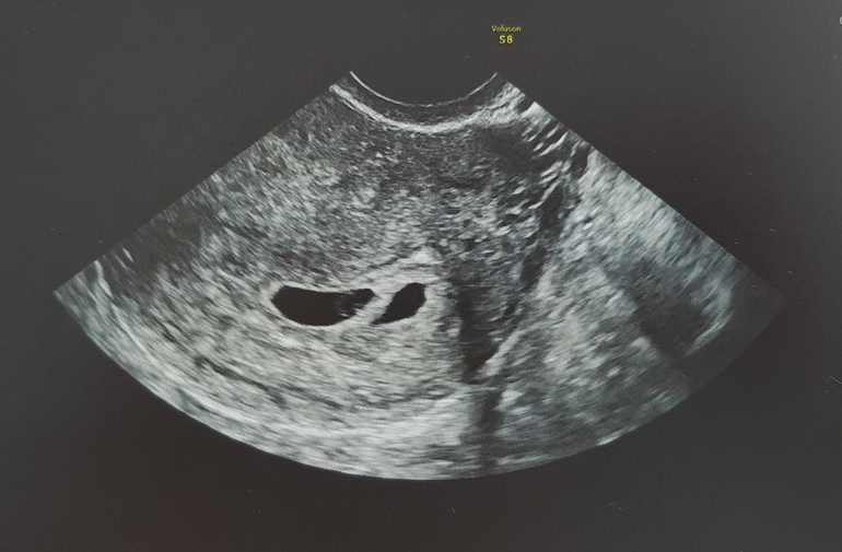 Фото эмбриона на 6 неделе