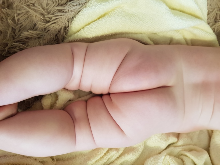 складочки на ножках не симметричны — 35 ответов | форум Babyblog