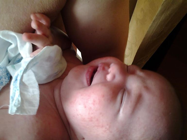 1,5 месяца. Высыпания на коже.