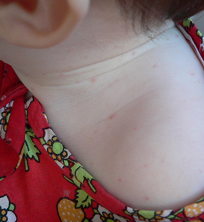 Аллергия или что?