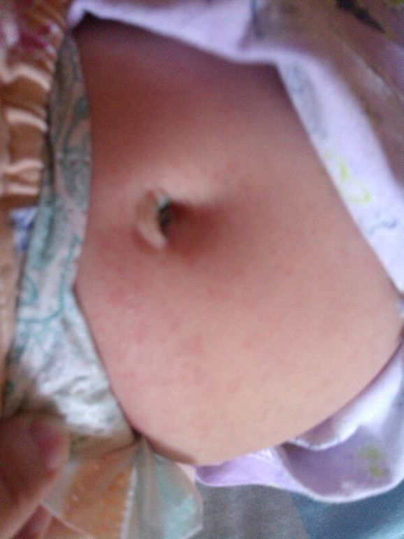 как понять, что это аллергия?