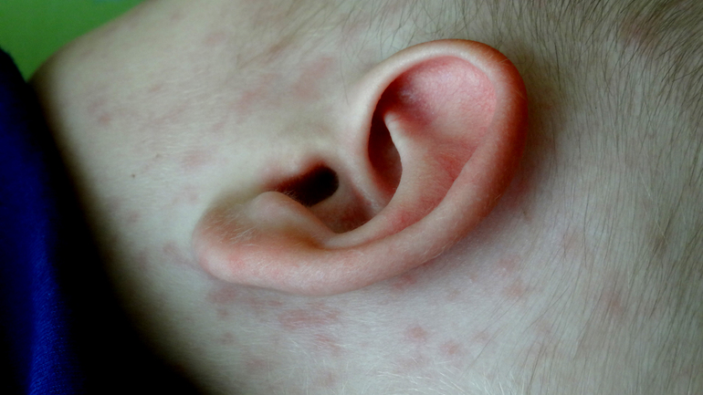 Это розеола?