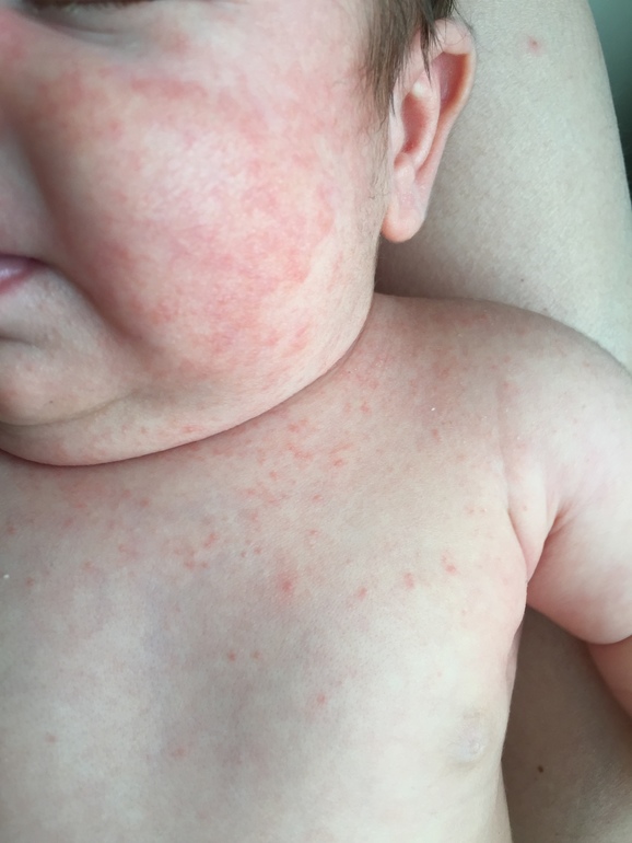 Аллергия. Как долго может проходить? — 25 ответов | форум Babyblog