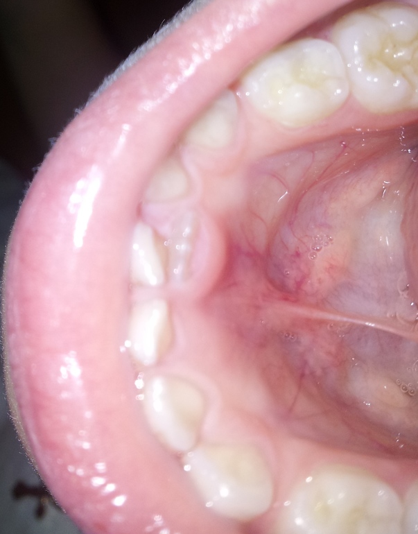 Смена молочных зубов