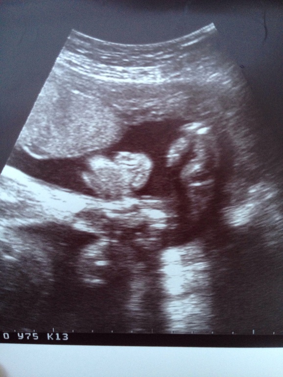 Узи 25 недель беременности фото мальчик