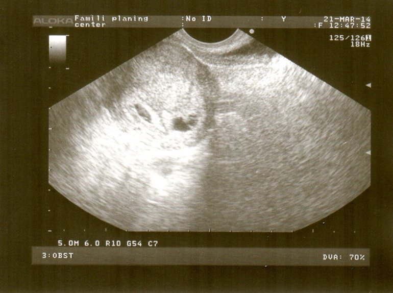 Мой поход на УЗИ!