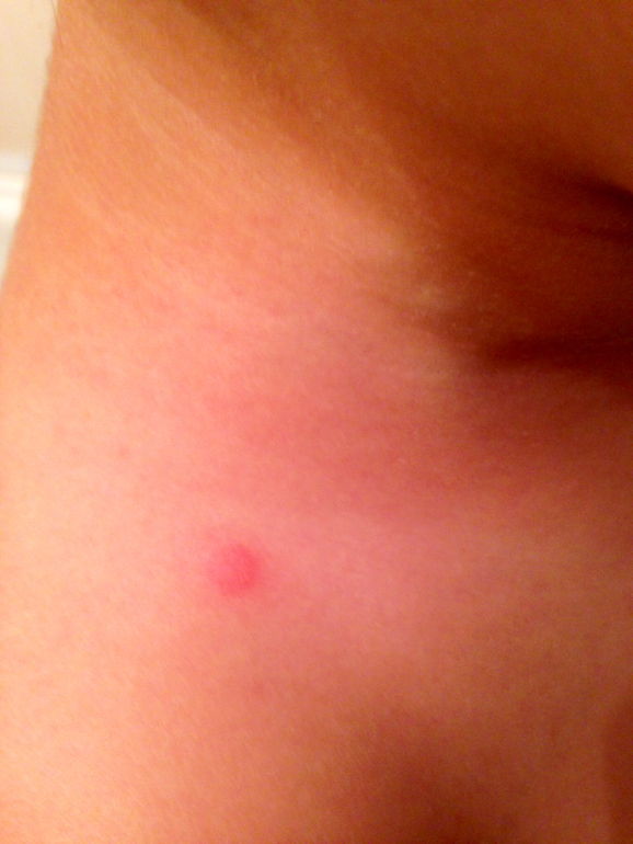 На чьи укусы похоже?