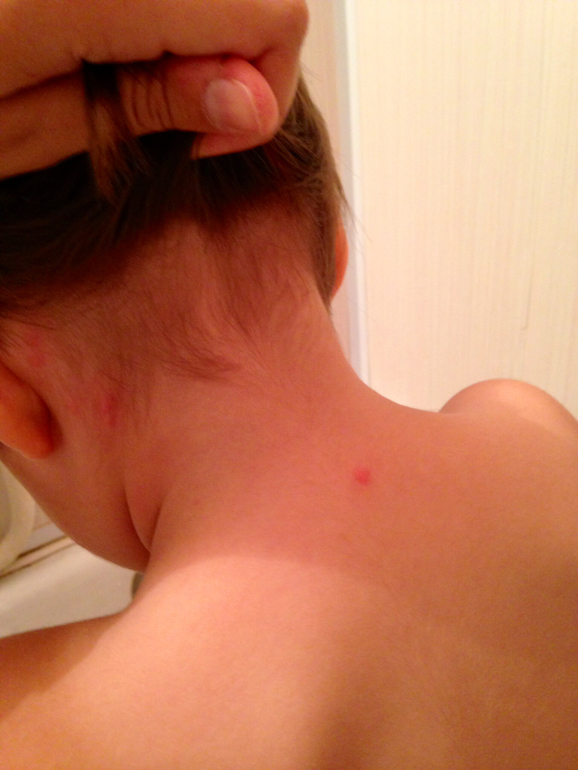 На чьи укусы похоже?