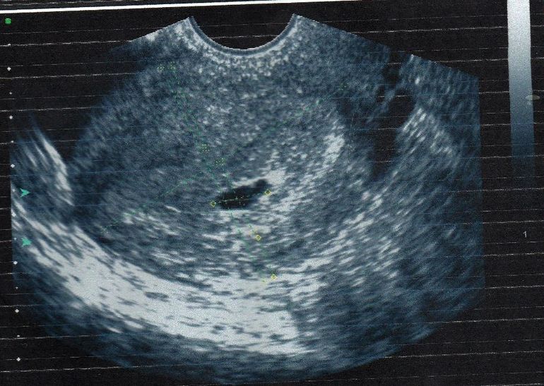 узи 5-6 недель)