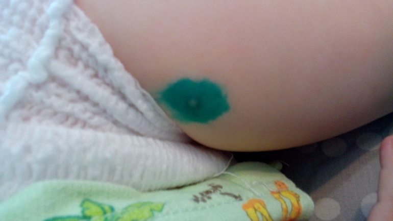 аллергия?укусы?ветрянка?