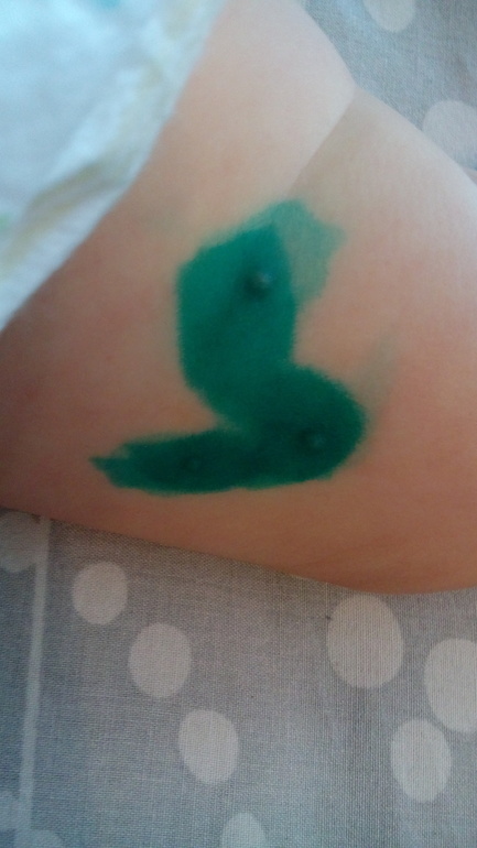 аллергия?укусы?ветрянка?